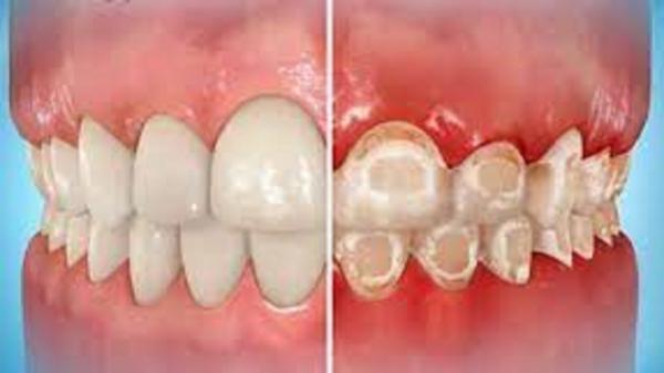 دلیل مشاهده لکه های سفید روی دندان؛ از پیشگیری تا درمان